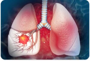 Central lung tumor