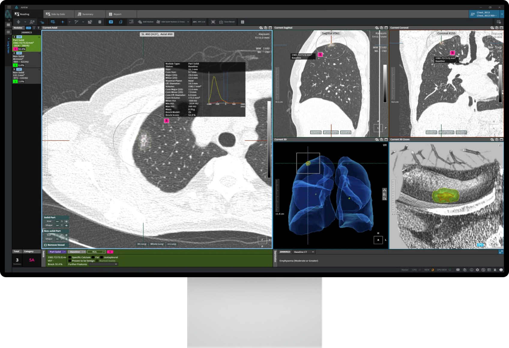 Giải pháp AI Coreline hỗ trợ chẩn đoán hình ảnh phổi