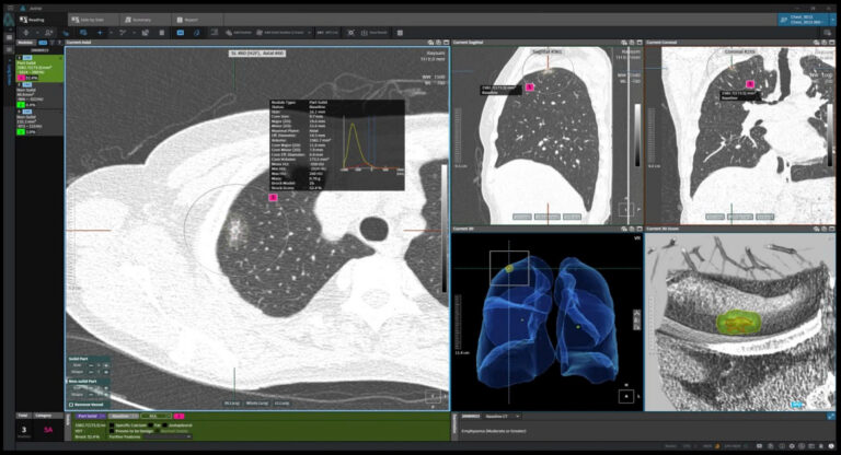 Giải pháp AI Coreline hỗ trợ chẩn đoán hình ảnh phổi