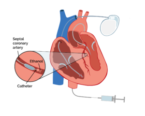 bệnh cơ tim phù đại