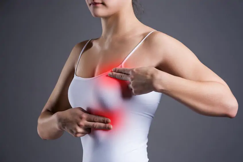 Sưng to một bên vú kèm nổi cục ở phụ nữ