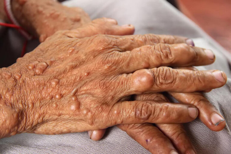 Các dấu hiệu và triệu chứng của bệnh u bao sợi thần kinh tiền đình thường rất dễ bỏ sót và thường cần thời gian dài để phát triển.