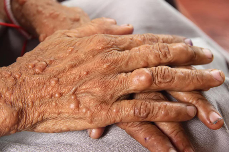 Các dấu hiệu và triệu chứng của bệnh u bao sợi thần kinh tiền đình thường rất dễ bỏ sót và thường cần thời gian dài để phát triển.