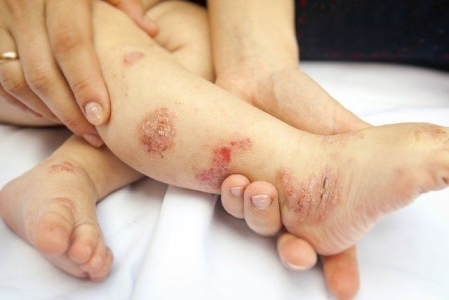 viêm da cơ địa ở trẻ