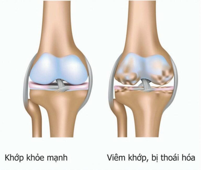 thoái hoá khớp gối
