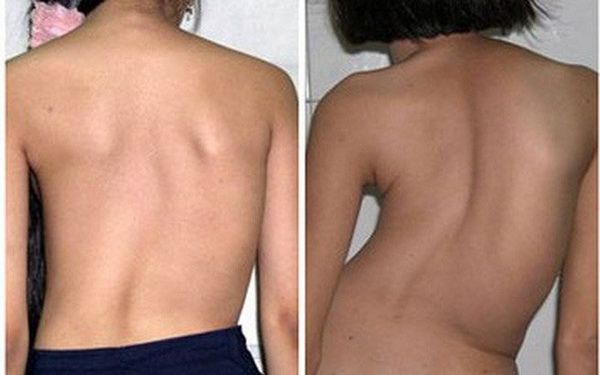 vẹo cột sống sớm
