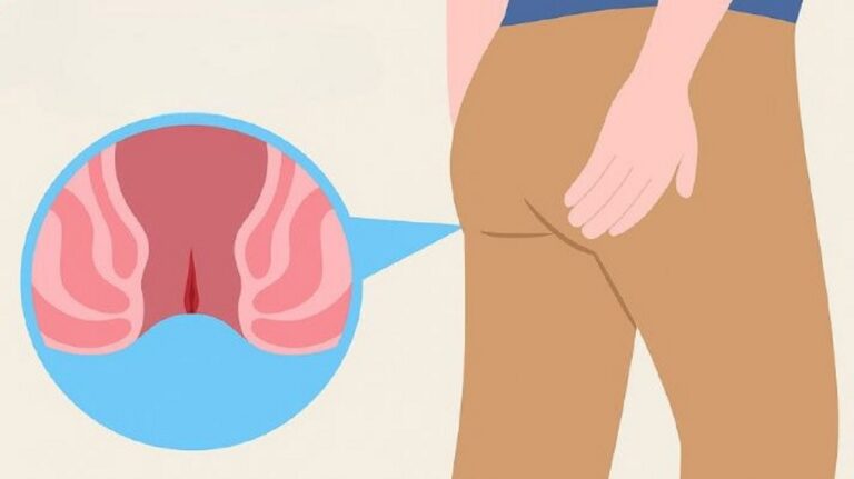 nứt hậu môn trĩ crohn