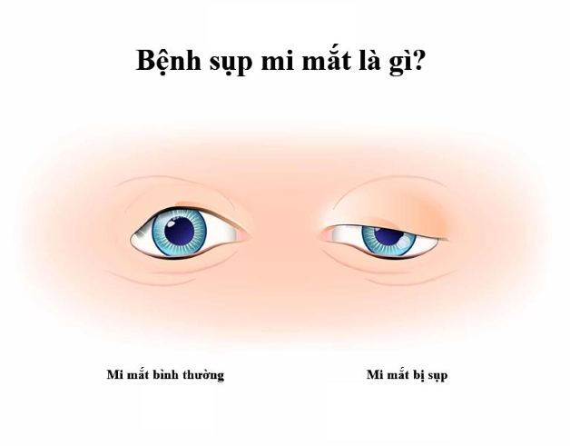 sụp mi mắt