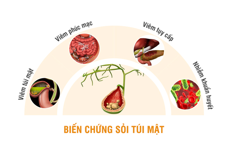 sỏi túi mật