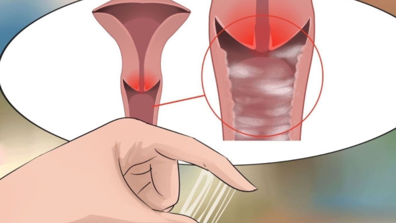 viêm âm đạo