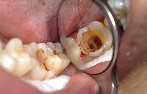 sâu răng giai đoạn sớm