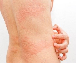 Dị Ứng Thuốc: Dấu Hiệu Cảnh Báo Nguy Hiểm Không Nên Bỏ Qua