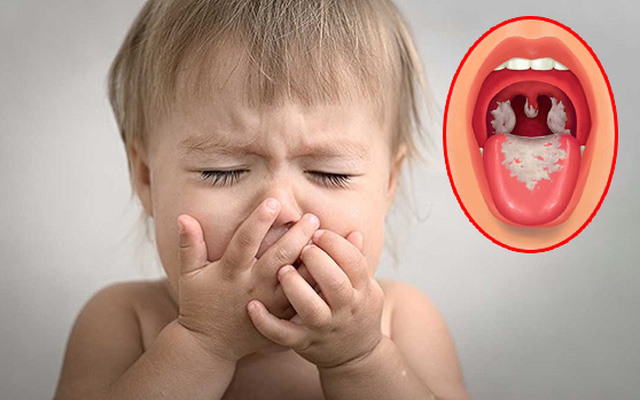 Bệnh bạch hầu: Dấu hiệu nhận biết và cách phòng ngừa hiệu quả