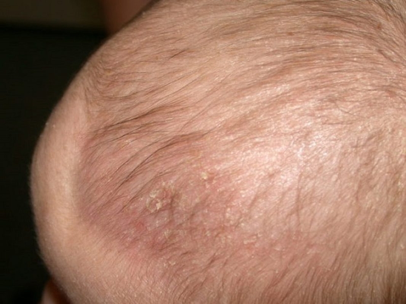 cứt trâu ở trẻ