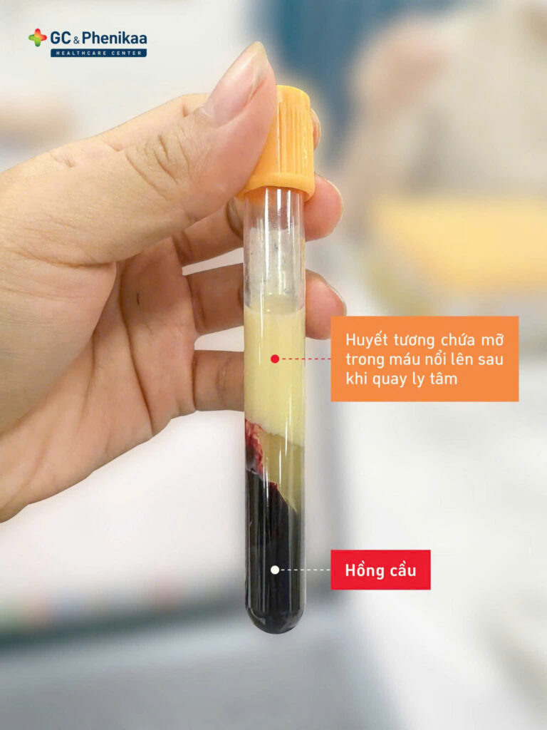 mỡ máu cao